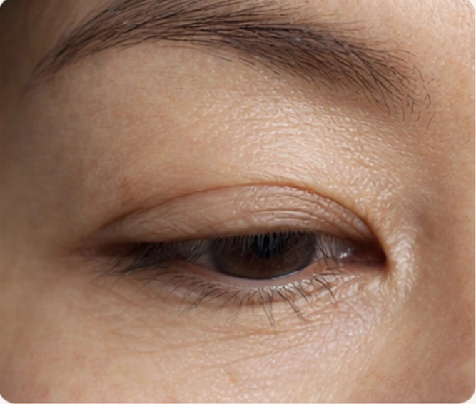 Droopy Eyelid