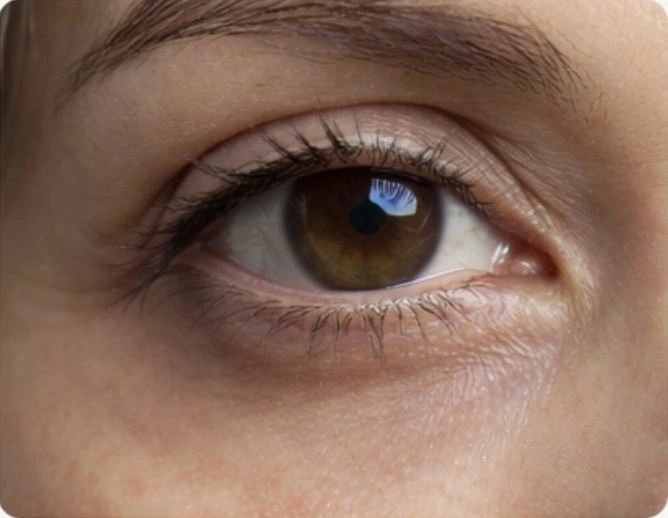 Hollow Under-Eye